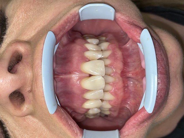 Marie D. before treatment