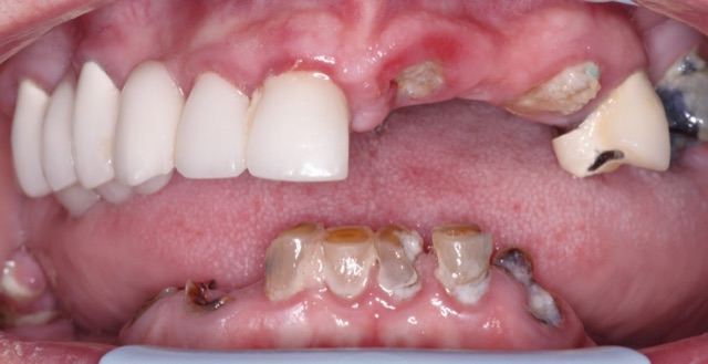 Amber F. before treatment