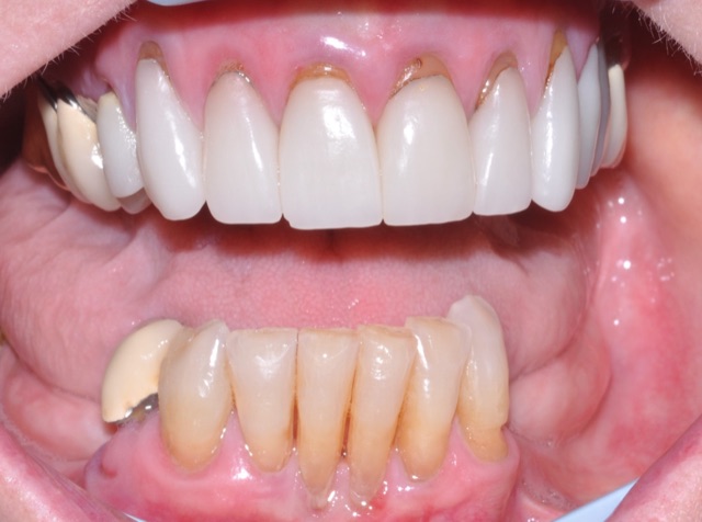 Marian F. before treatment
