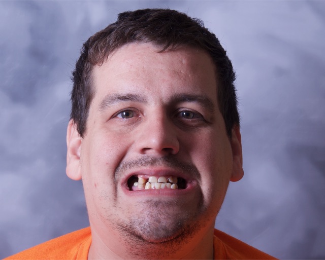 William L. before treatment