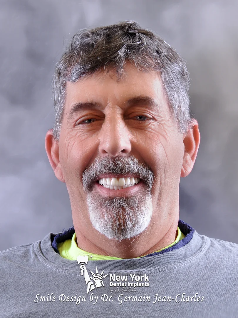 Dave B. after complete restoration treatment at New York Dental Implants