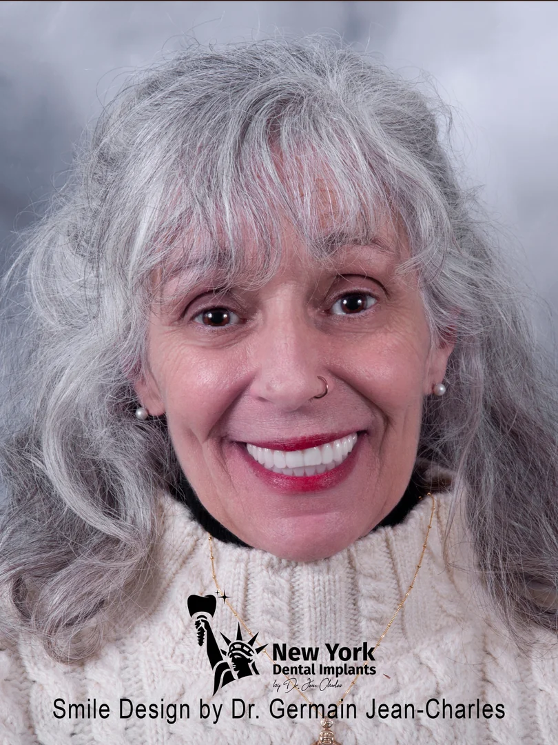C. Howell after all-on-4 treatment at New York Dental Implants