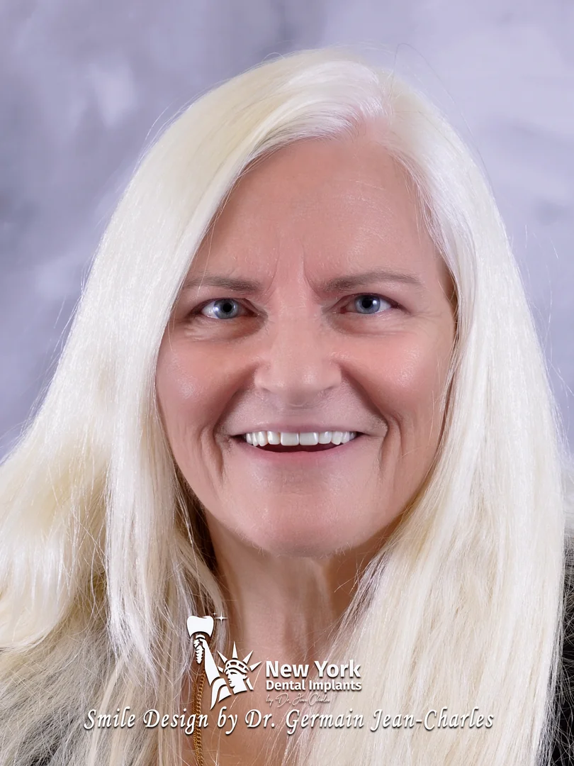 Amber F. after all-on-4 treatment at New York Dental Implants