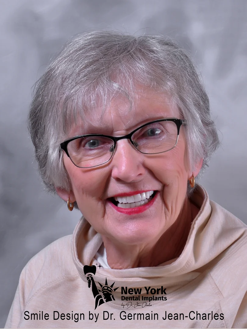Marian F. after full mouth restoration treatment at New York Dental Implants