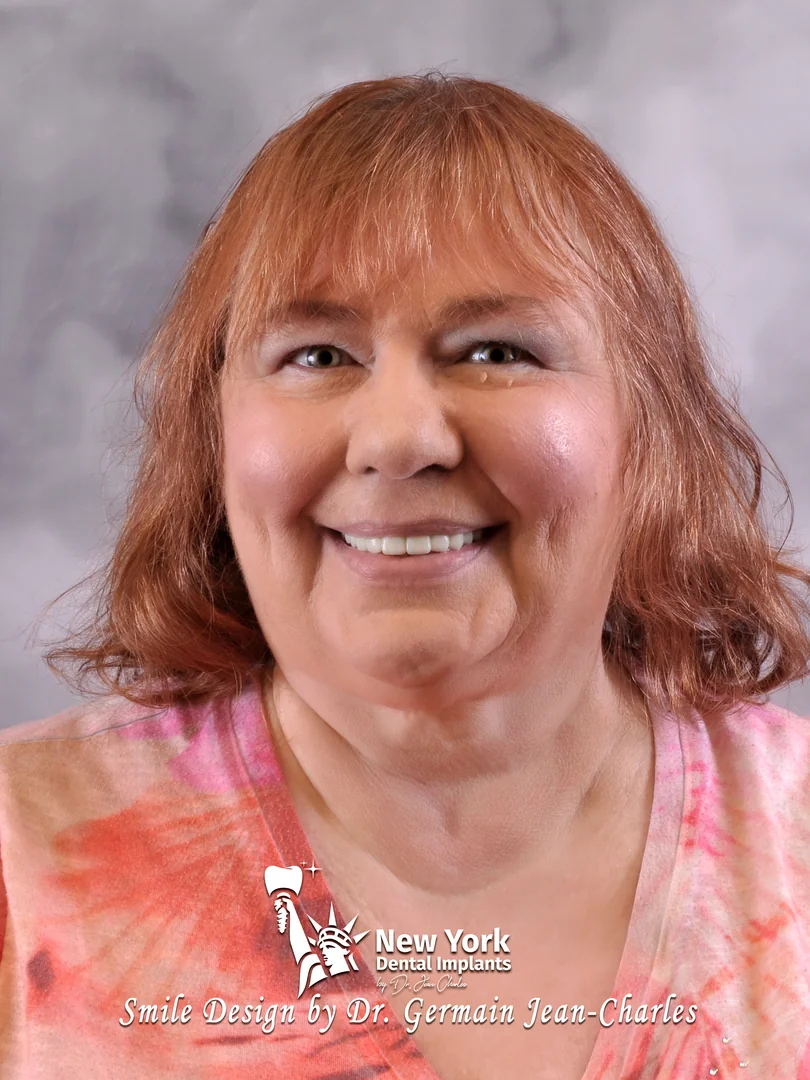 Karen M. after all-on-4 treatment at New York Dental Implants