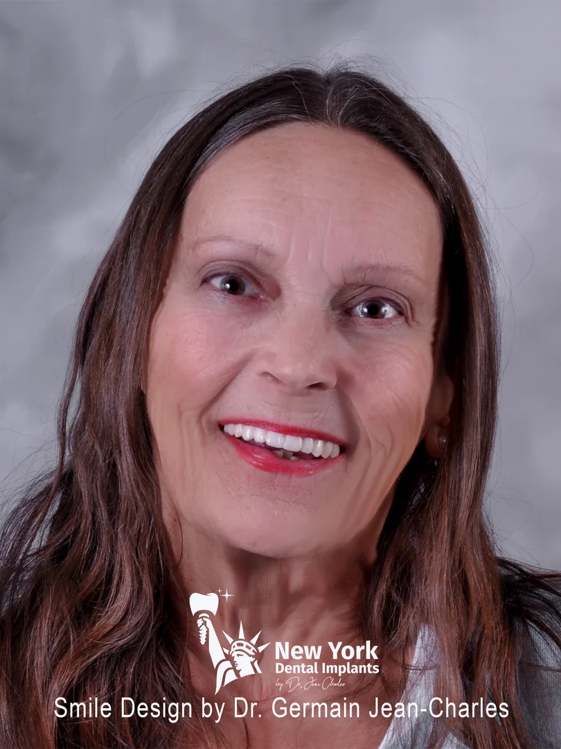 Linda S. after implant bridge treatment at New York Dental Implants