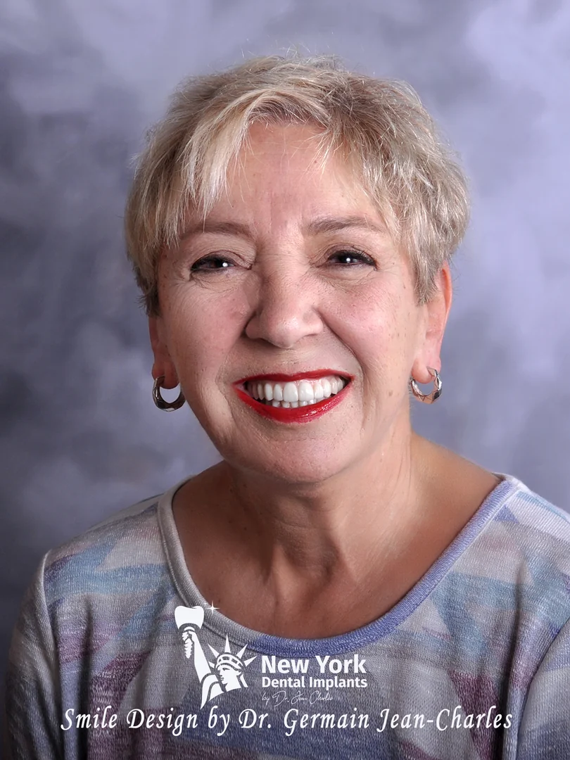 Mary S. after smile makeover treatment at New York Dental Implants