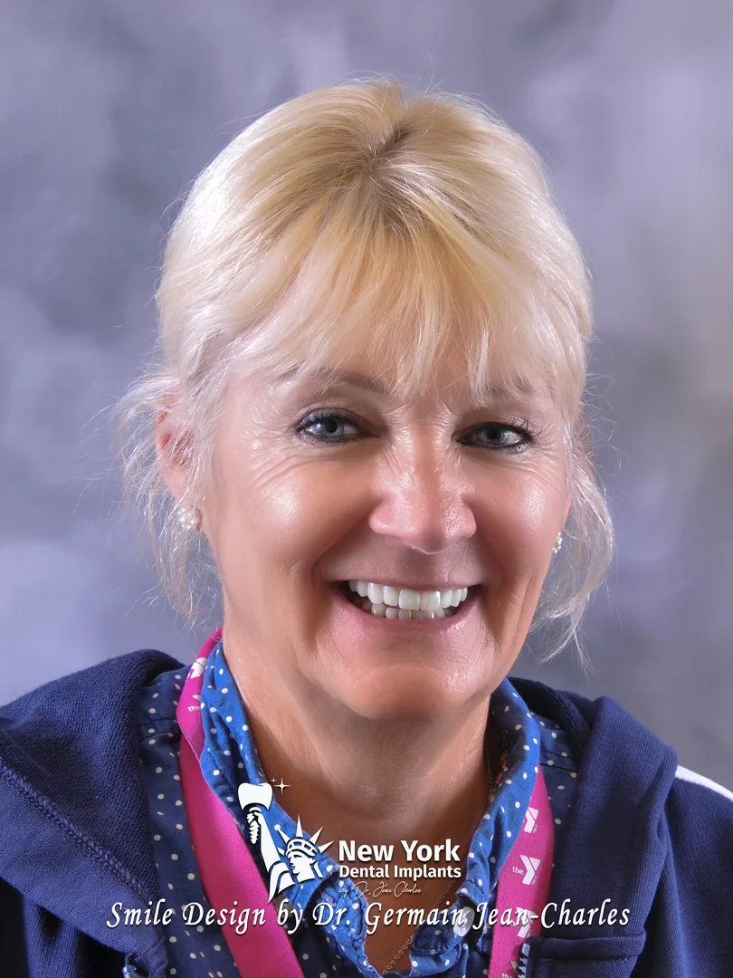 Suzanne V. after smile makeover treatment at New York Dental Implants